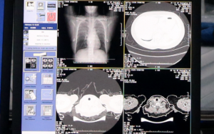 阿里云向全球免费开放新冠AI技术